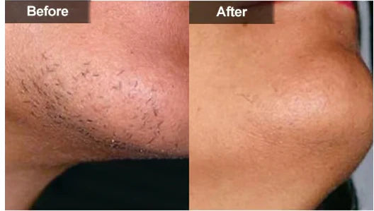 Petalune™ – Gentle Painless Facial Hair Removal Cream with Shea Butter &amp; Centella + 1+1 FREE