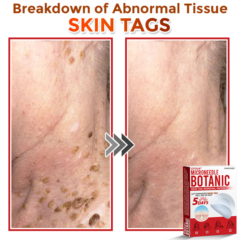 The MicroDerm Patch - Painless Skin Tag &amp; Blemish Removal + 50% OFF