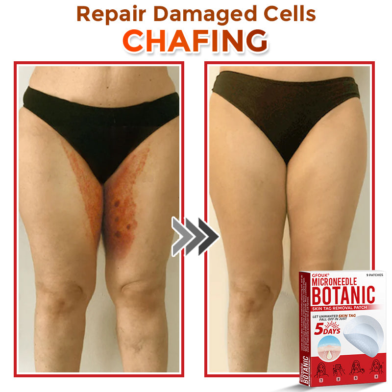 The AuraClear Skin Tag Patch - Botanic MicroNeedle Removal, Visible Results + 50% OFF