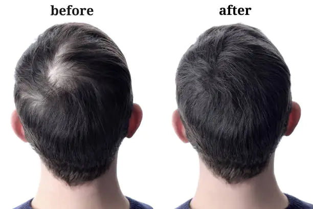 Folli-Gen - Reawaken Your Hair&