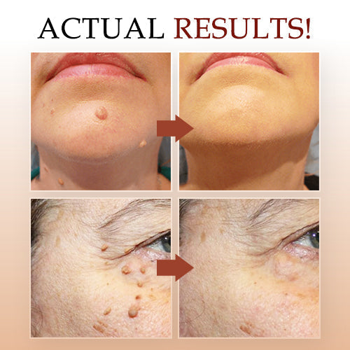1 + 1 Free - WipeOff™ Marker &amp; Mole Remover